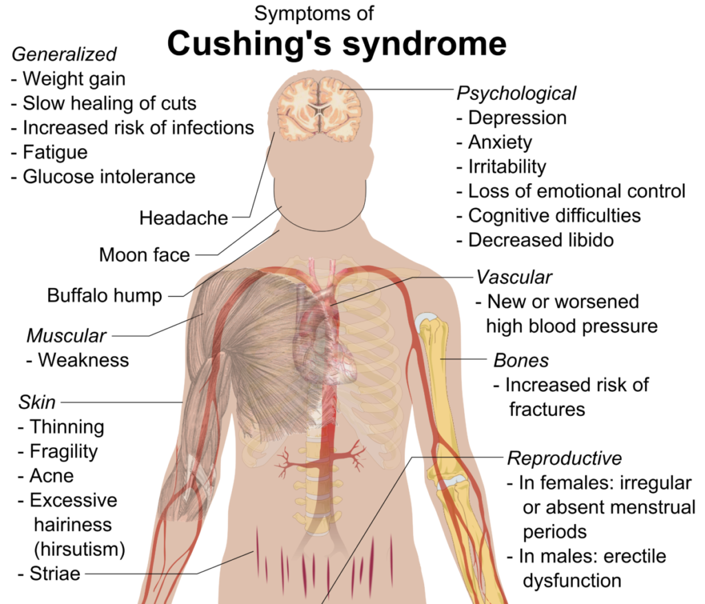 When Does Cushing Syndrome Start? Understanding the Onset of This Endocrine Disorder