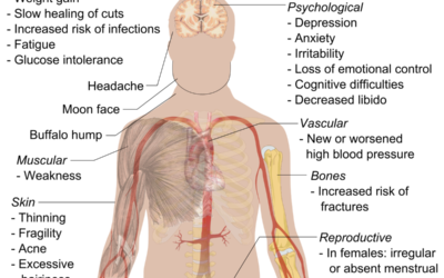 Cushing Syndrome